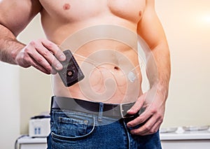 Diabetic man with an insulin pump connected in his abdomen