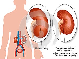 Diabetic nephropathy photo