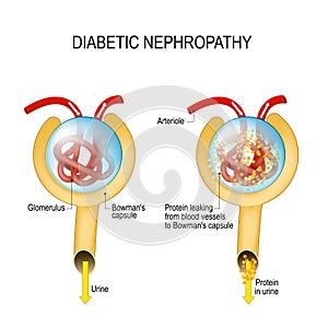 Diabetic nephropathy. diabetic kidney disease