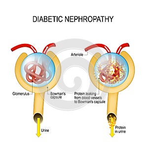 Diabetic nephropathy. diabetic kidney disease photo