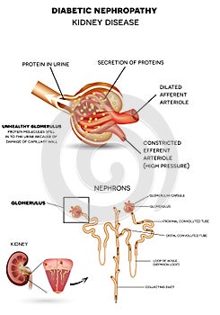 Diabetic Nephropathy, kidney disease