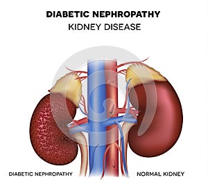 Diabetic Nephropathy, kidney disease photo