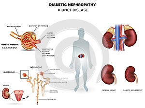 Diabetic Nephropathy, kidney disease photo