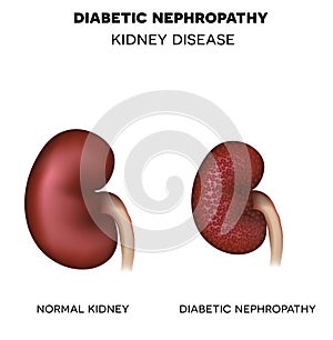 Diabetic Nephropathy, kidney disease photo