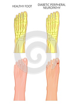 Diabetic Peripheral Neuropathy