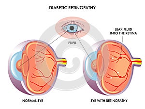 Diabetic retinopathy photo