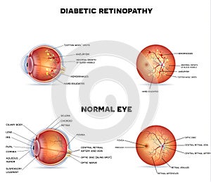 Diabetic retinopathy