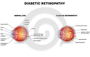 Diabetic retinopathy