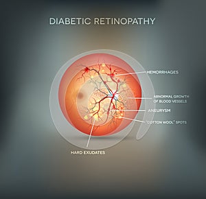 Diabetic retinopathy background photo