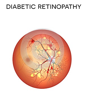 Diabetic retinopathy photo