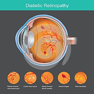 Diabetic Retinopathy. Illustration abnormality the retina from symptoms the diabetic