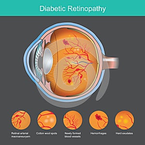 Diabetic Retinopathy. Illustration abnormality the retina from symptoms the diabetic photo