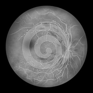 Diabetic retinopathy, ophthalmoscopic diagnosis, illustration