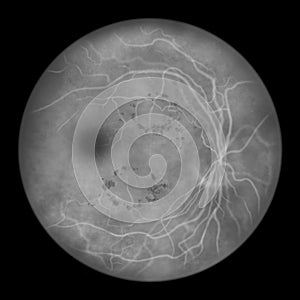 Diabetic retinopathy, ophthalmoscopic diagnosis, illustration