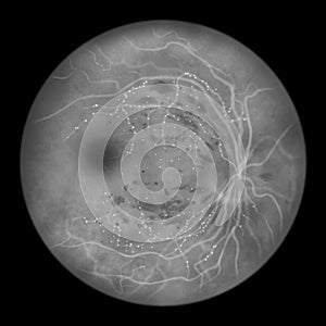 Diabetic retinopathy, ophthalmoscopic diagnosis, illustration