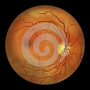 Diabetic retinopathy, ophthalmoscopic diagnosis, illustration