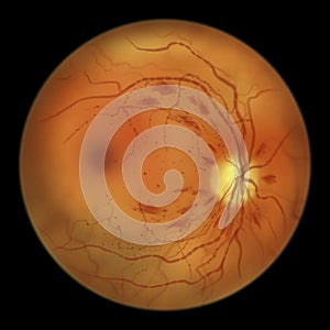 Diabetic retinopathy, ophthalmoscopic diagnosis, illustration