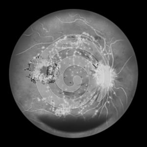 Diabetic retinopathy, ophthalmoscopic diagnosis, illustration