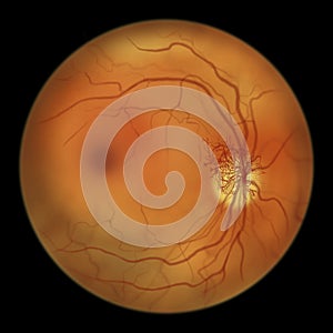 Diabetic retinopathy, ophthalmoscopic diagnosis, illustration