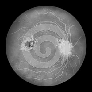 Diabetic retinopathy, ophthalmoscopic diagnosis, illustration