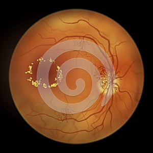 Diabetic retinopathy, ophthalmoscopic diagnosis, illustration