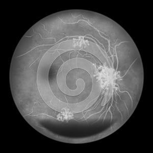 Diabetic retinopathy, ophthalmoscopic diagnosis, illustration