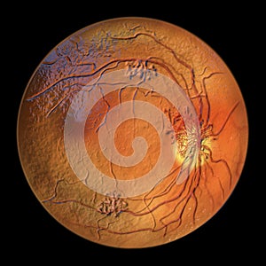 Diabetic retinopathy, ophthalmoscopic diagnosis, illustration