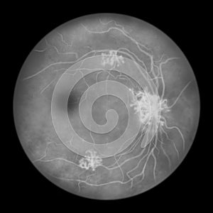 Diabetic retinopathy, ophthalmoscopic diagnosis, illustration