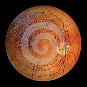 Diabetic retinopathy, ophthalmoscopic diagnosis, illustration