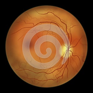 Diabetic retinopathy, ophthalmoscopic diagnosis, illustration photo