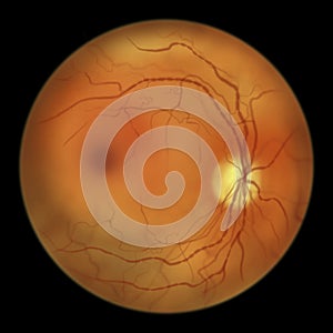 Diabetic retinopathy, ophthalmoscopic diagnosis, illustration photo