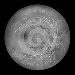 Diabetic retinopathy, ophthalmoscopic diagnosis, illustration photo