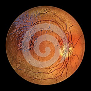 Diabetic retinopathy, ophthalmoscopic diagnosis, illustration photo