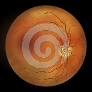 Diabetic retinopathy, ophthalmoscopic diagnosis, illustration photo