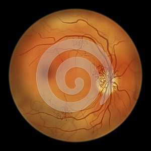 Diabetic retinopathy, ophthalmoscopic diagnosis, illustration photo