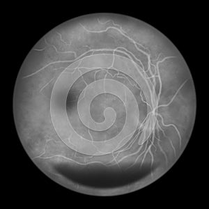 Diabetic retinopathy, ophthalmoscopic diagnosis, illustration photo