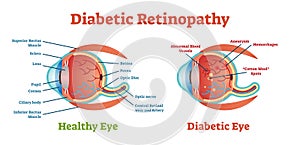 Diabetic Retinopathy vector illustration diagram, anatomical scheme.