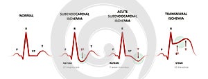 Diagnosis of Myocardial Ischemia photo