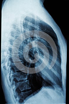 Diagnosis with x-ray. Fluorography of the human chest, side view