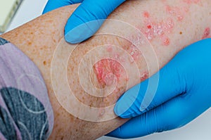 Diagnosis of skin diseases - allergies, psoriasis, eczema, dermatitis. A dermatologist with gloves examines the skin of the elbow