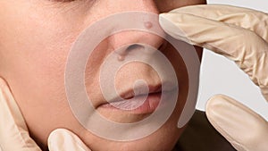 Diagnosis of skin mole or nevus on woman`s face. Doctor`s hands in surgical gloves examining nevi on nose. Closeup