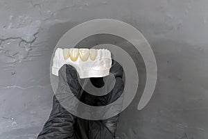 Diagnostic model with veneers of the front teeth in the hand of a dental technician on a dark background