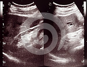 Diagnostic sonography of abdomen photo