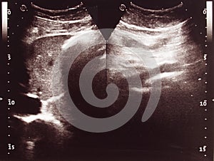 Diagnostic sonography of abdomen photo