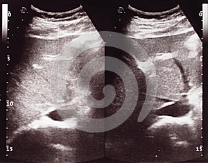 Diagnostic sonography of abdomen photo