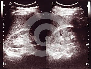 Diagnostic sonography of abdomen photo