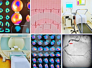 Diagnostics cardiac ischemia collage