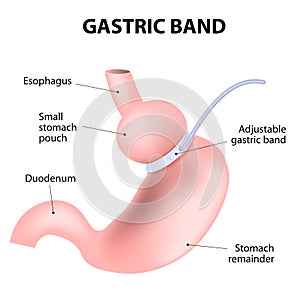 Diagram of an adjustable gastric band