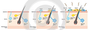 Diagram of body odor and sweat glands. Human skin layer illustration for medical and health care use