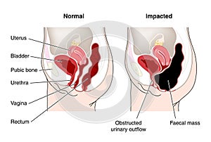 Diagram of constipated bowel